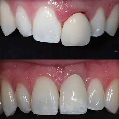 before-and-after-implant-4.jpg (1)